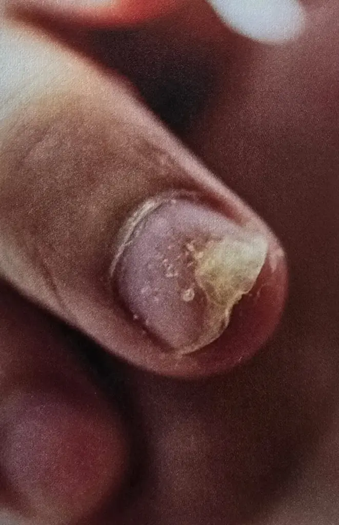 psorijaza nokti